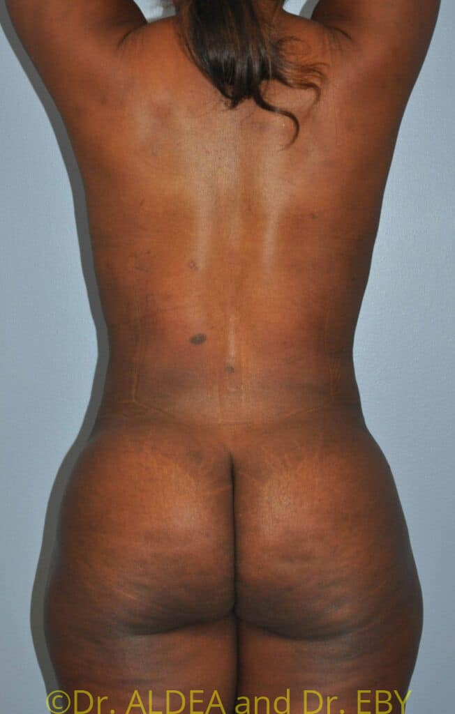 After Image: Back Scoop Liposuction #280 - back