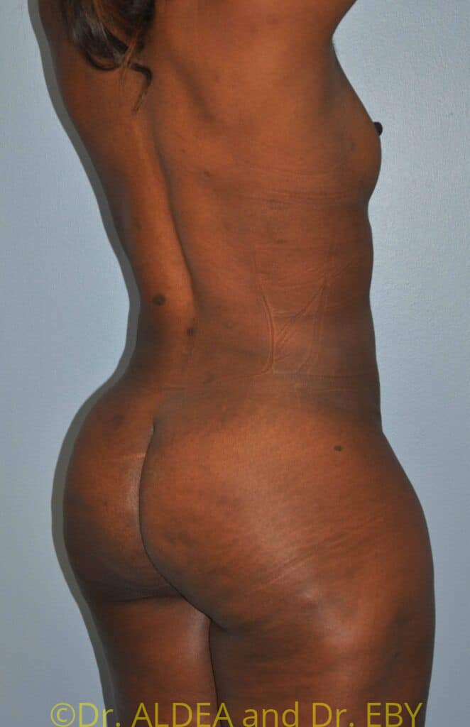 After Image: Back Scoop Liposuction #280 - right-back-oblique