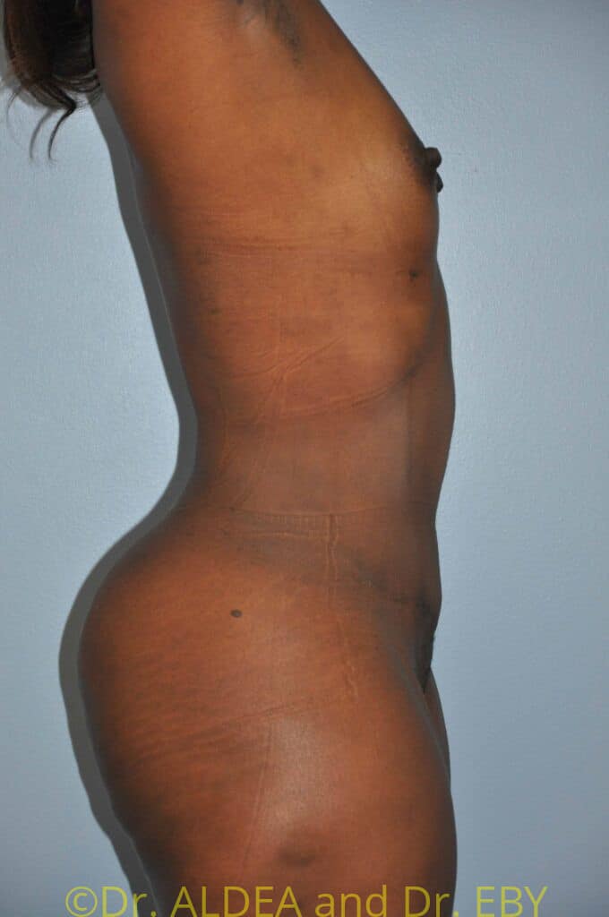 After Image: Back Scoop Liposuction #280 - right-side