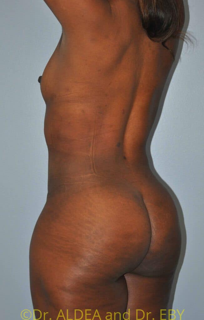 After Image: Back Scoop Liposuction #280 - left-back-oblique