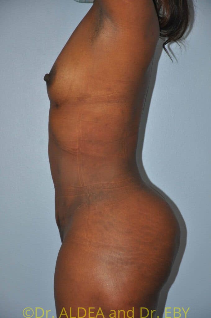 After Image: Back Scoop Liposuction #280 - left-side
