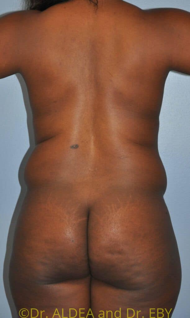 Before Image: Back Scoop Liposuction #280 - back