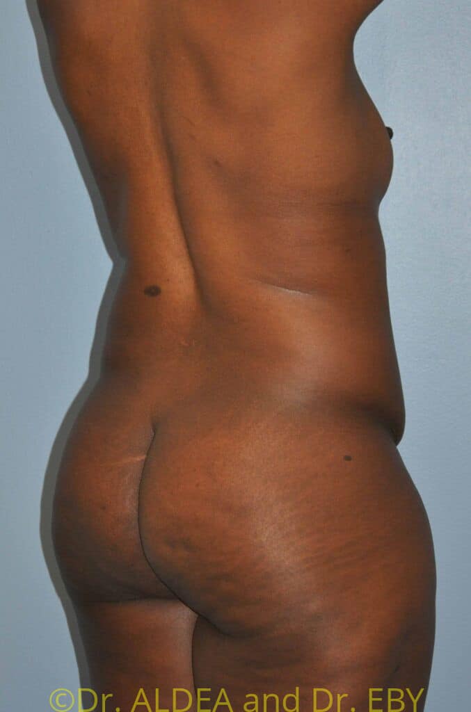 Before Image: Back Scoop Liposuction #280 - right-back-oblique