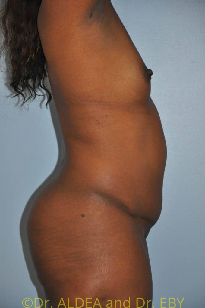 Before Image: Back Scoop Liposuction #280 - right-side