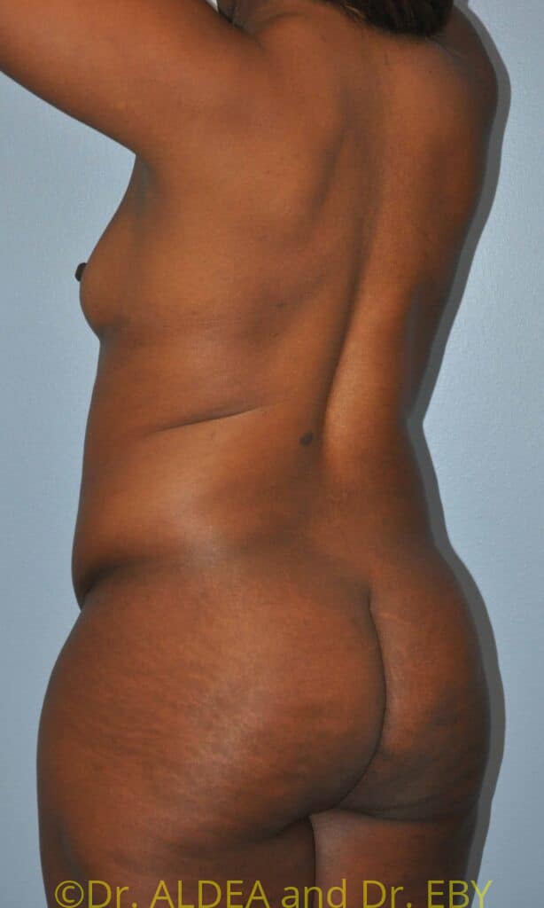 Before Image: Back Scoop Liposuction #280 - left-back-oblique