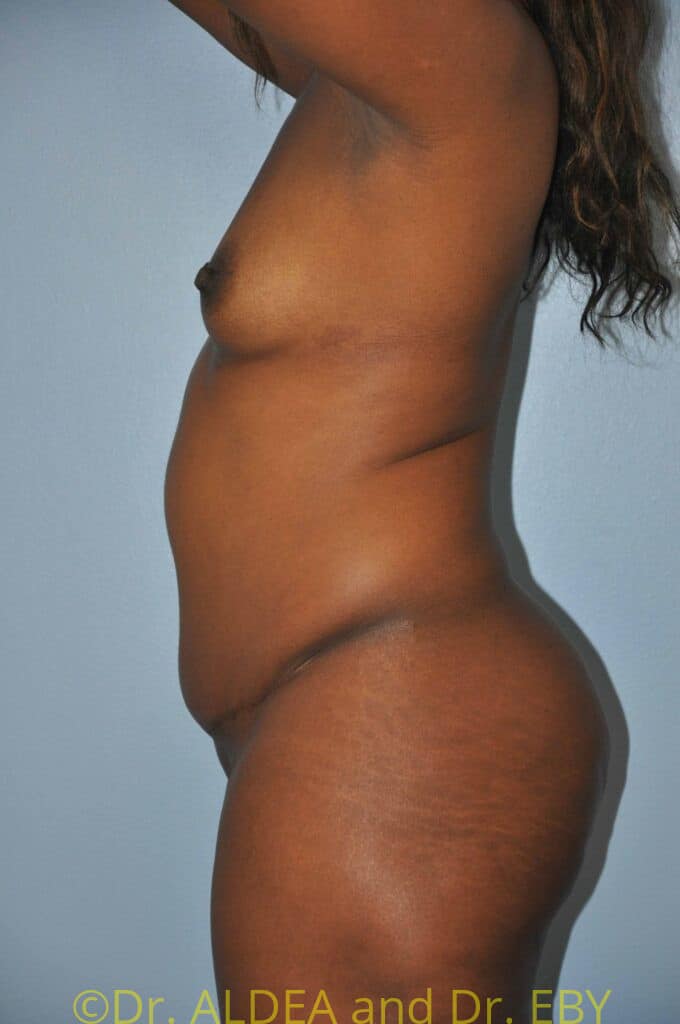 Before Image: Back Scoop Liposuction #280 - left-side