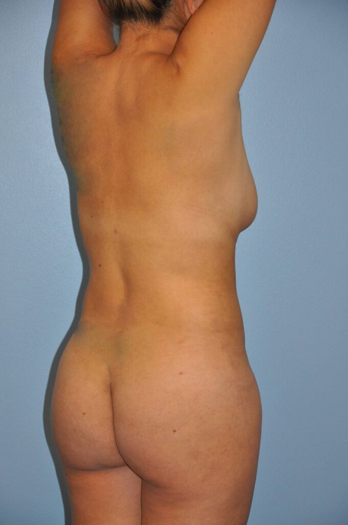 After Image: Precision BBL #998 - right-back-oblique