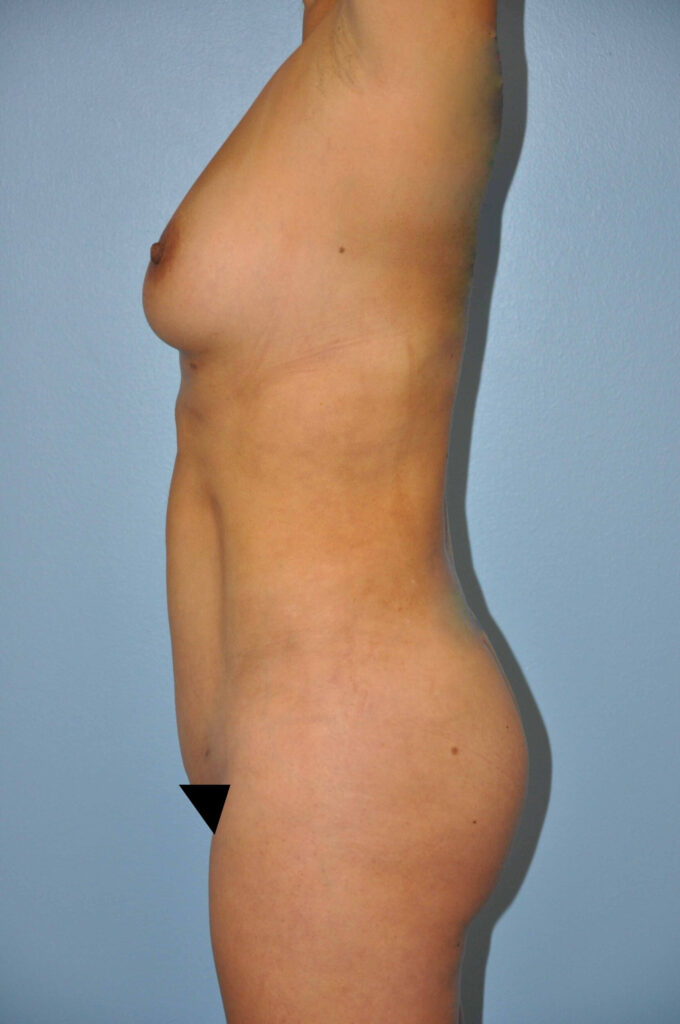 After Image: Precision BBL #998 - left-side