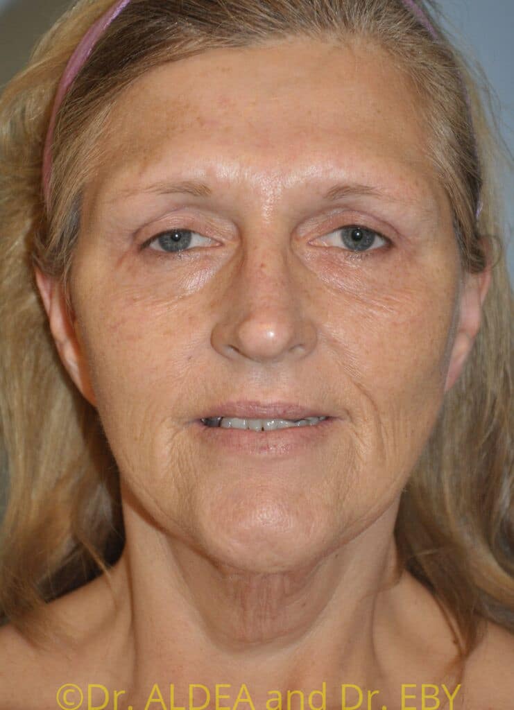 Before Image: Facelift #695 - front