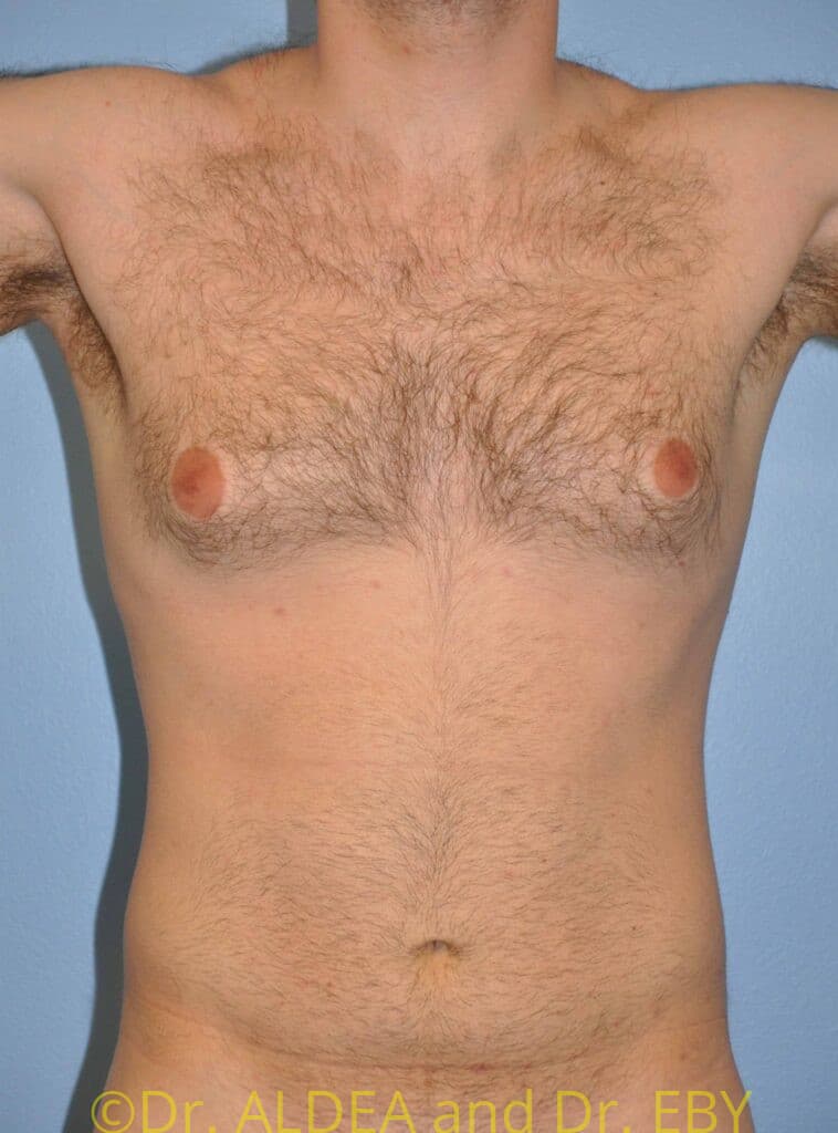 Before Image: Gynecomastia #465 - front