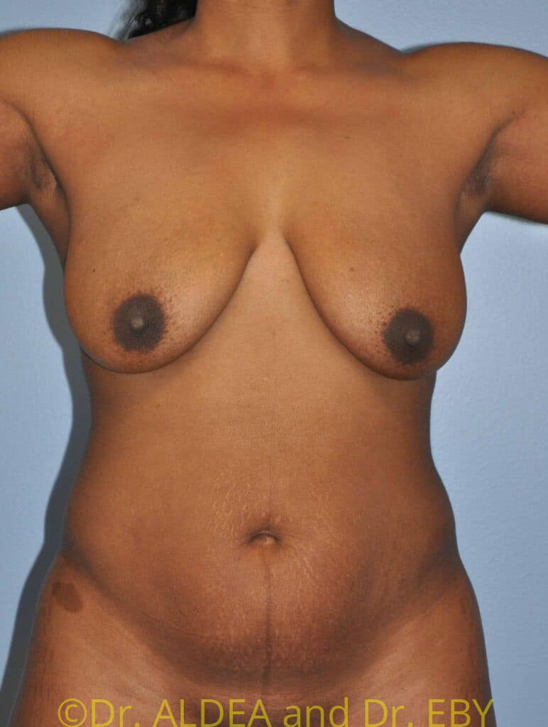 Before Image: Liposuction #467 - front