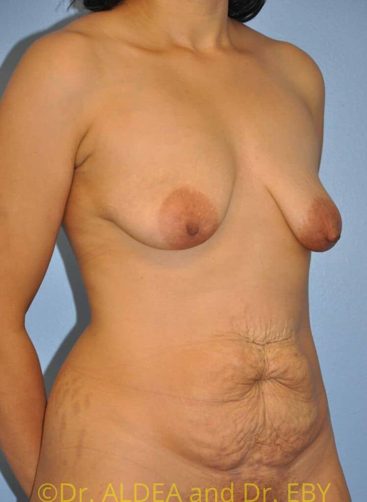 Before Image: Mommy Makeover #435 - right-front-oblique
