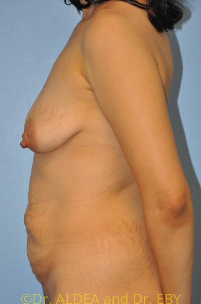 Before Image: Mommy Makeover #435 - left-side