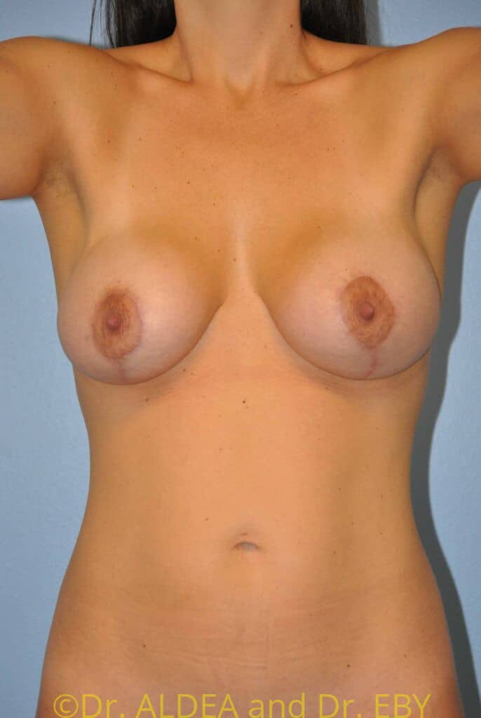 After Image: Breast Augmentation w/ Lift #588 - front