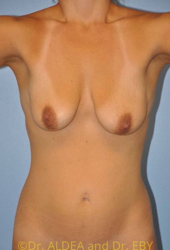 Before Image: Breast Augmentation w/ Lift #588 - front