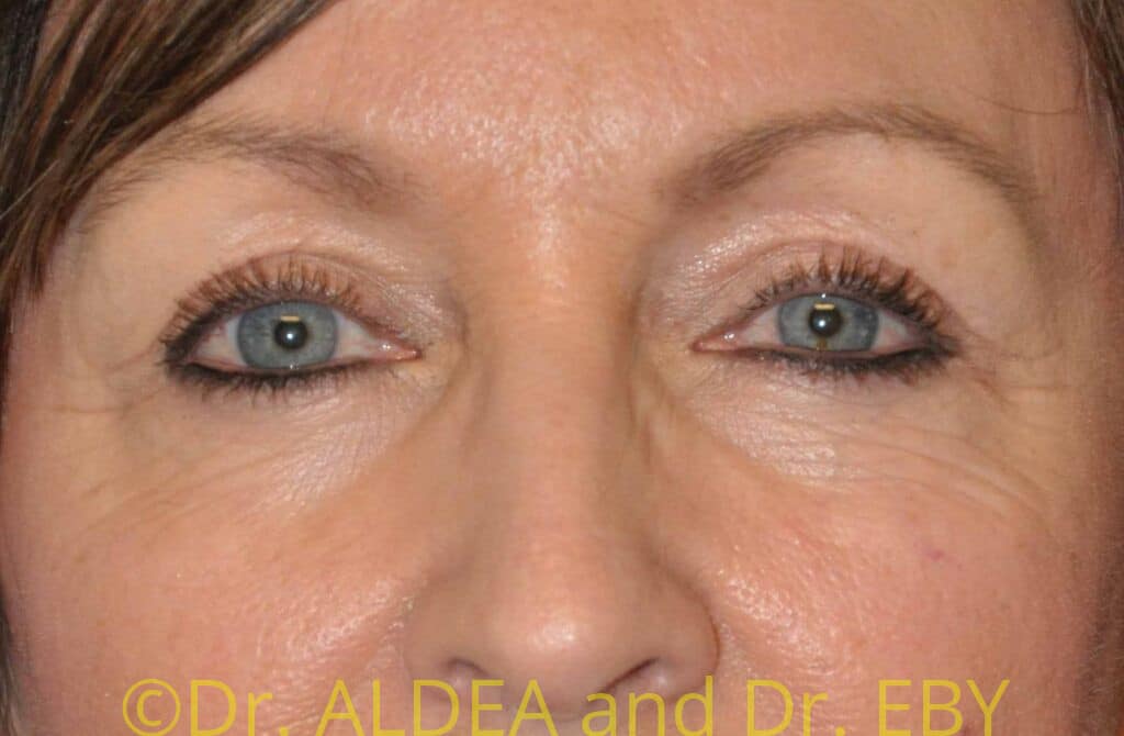 After Image: Blepharoplasty #282 - front