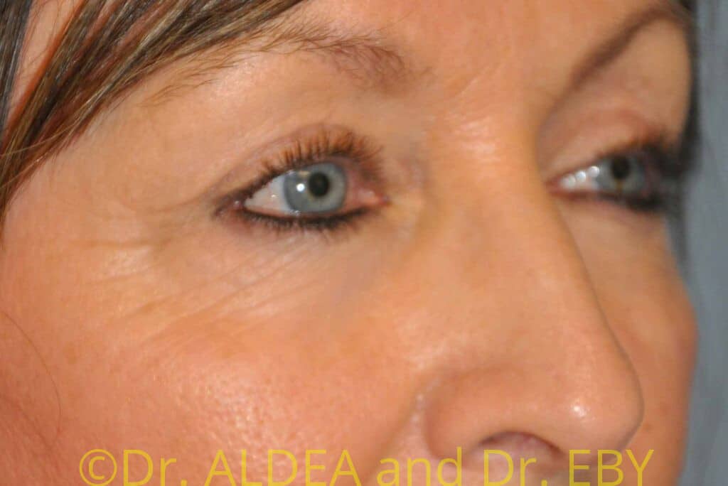 After Image: Blepharoplasty #282 - right-front-oblique