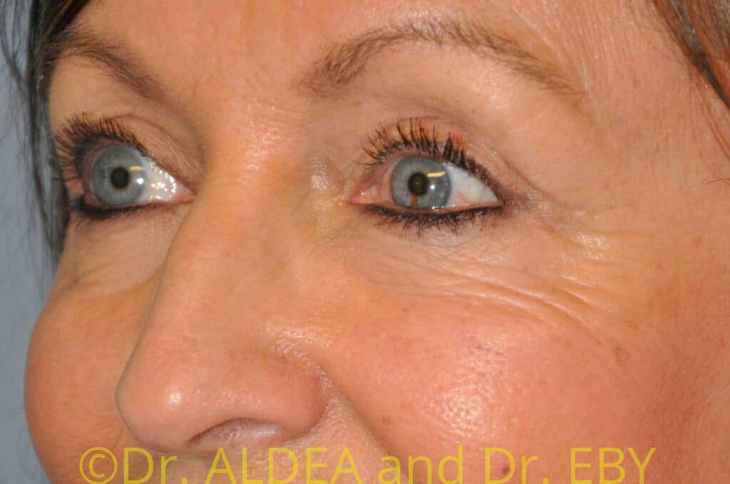 After Image: Blepharoplasty #282 - left-front-oblique