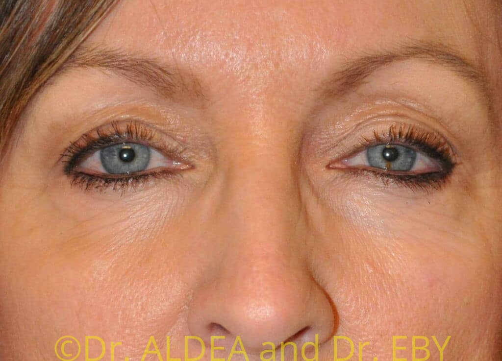 Before Image: Blepharoplasty #282 - front