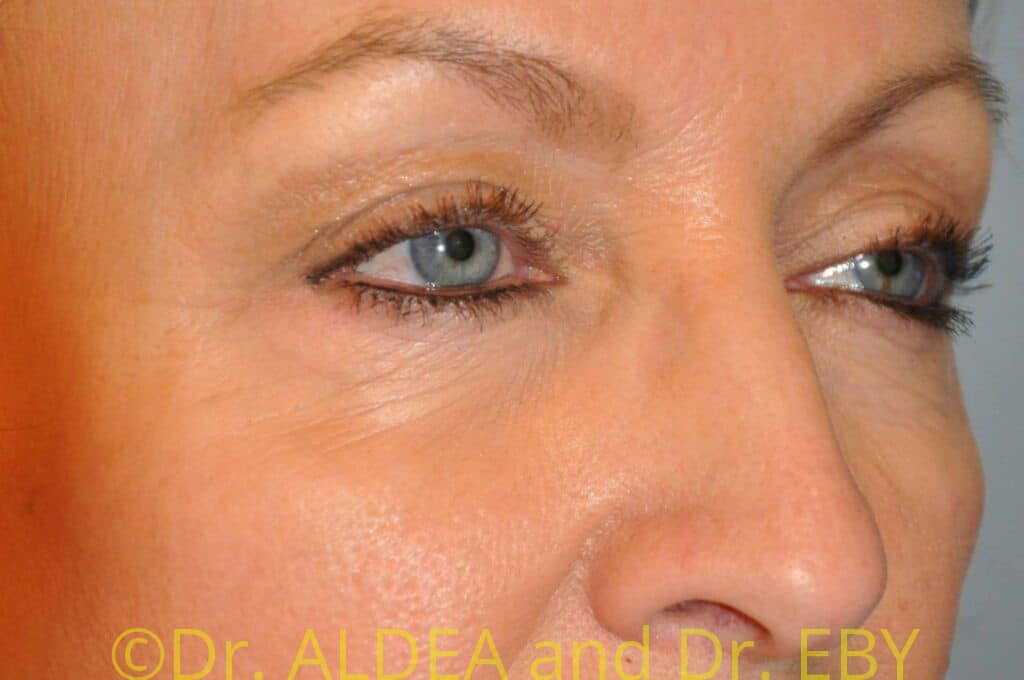 Before Image: Blepharoplasty #282 - right-front-oblique