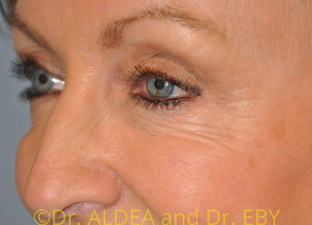 Before Image: Blepharoplasty #282 - left-front-oblique