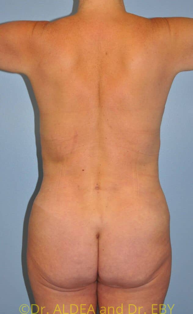 After Image: Back Scoop Liposuction #877 - back