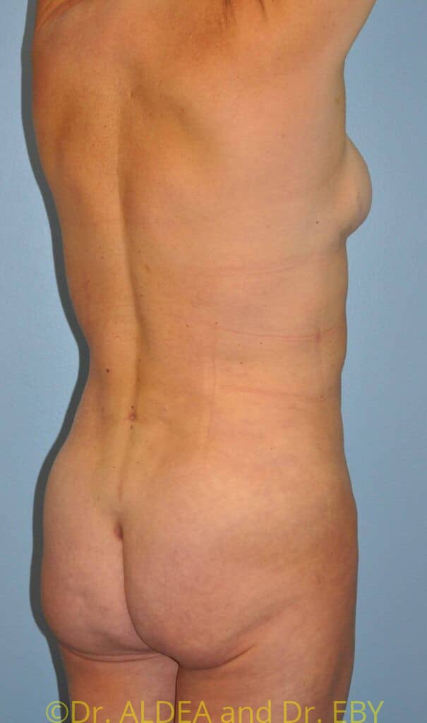 After Image: Back Scoop Liposuction #877 - right-back-oblique