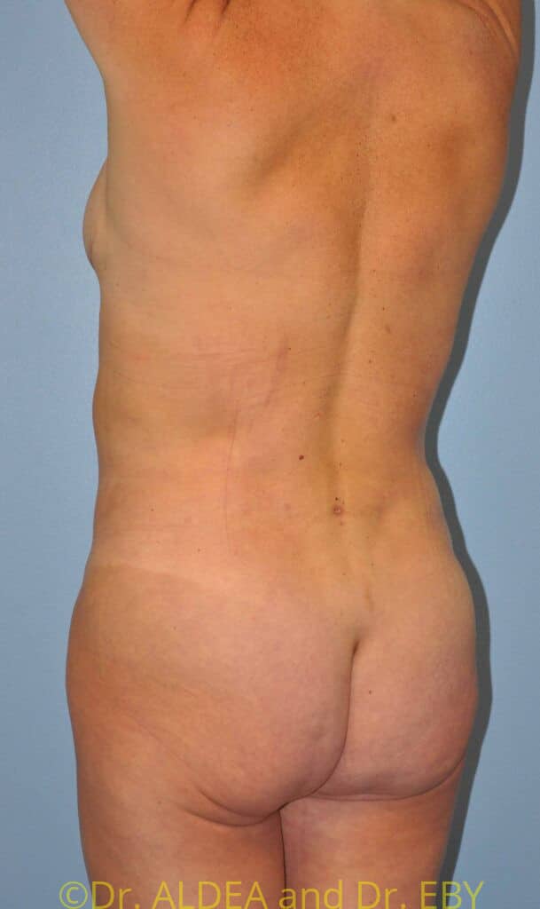 After Image: Back Scoop Liposuction #877 - left-back-oblique