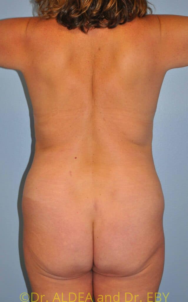 Before Image: Back Scoop Liposuction #877 - back