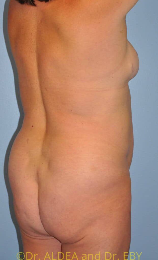 Before Image: Back Scoop Liposuction #877 - right-back-oblique