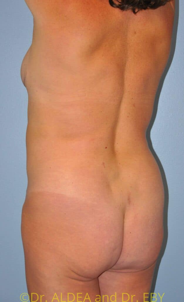 Before Image: Back Scoop Liposuction #877 - left-back-oblique