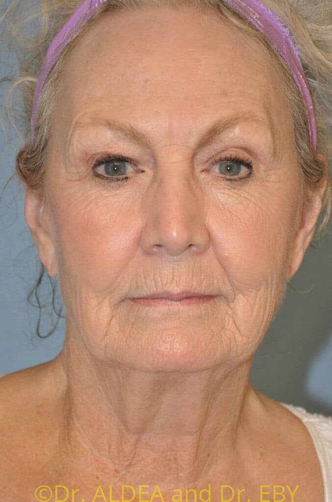 Before Image: Facelift #561 - front