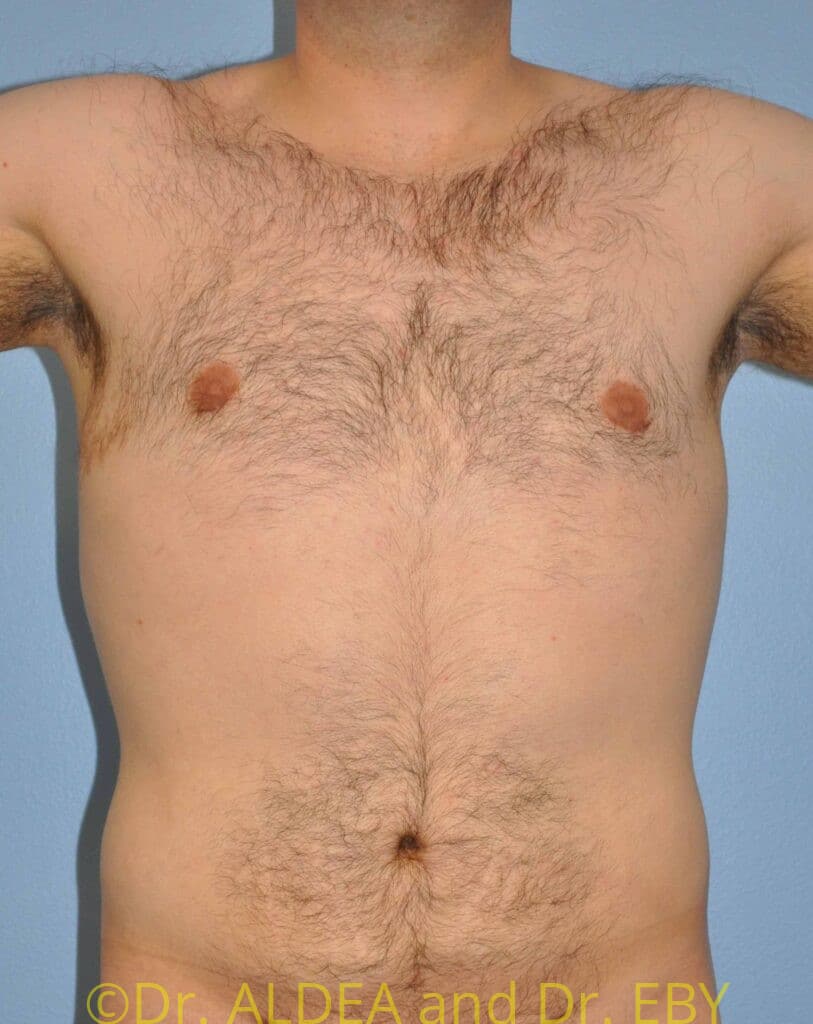 Before Image: Gynecomastia #945 - front