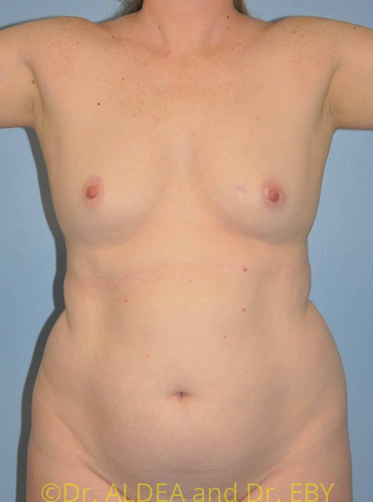 Before Image: Liposuction #462 - front