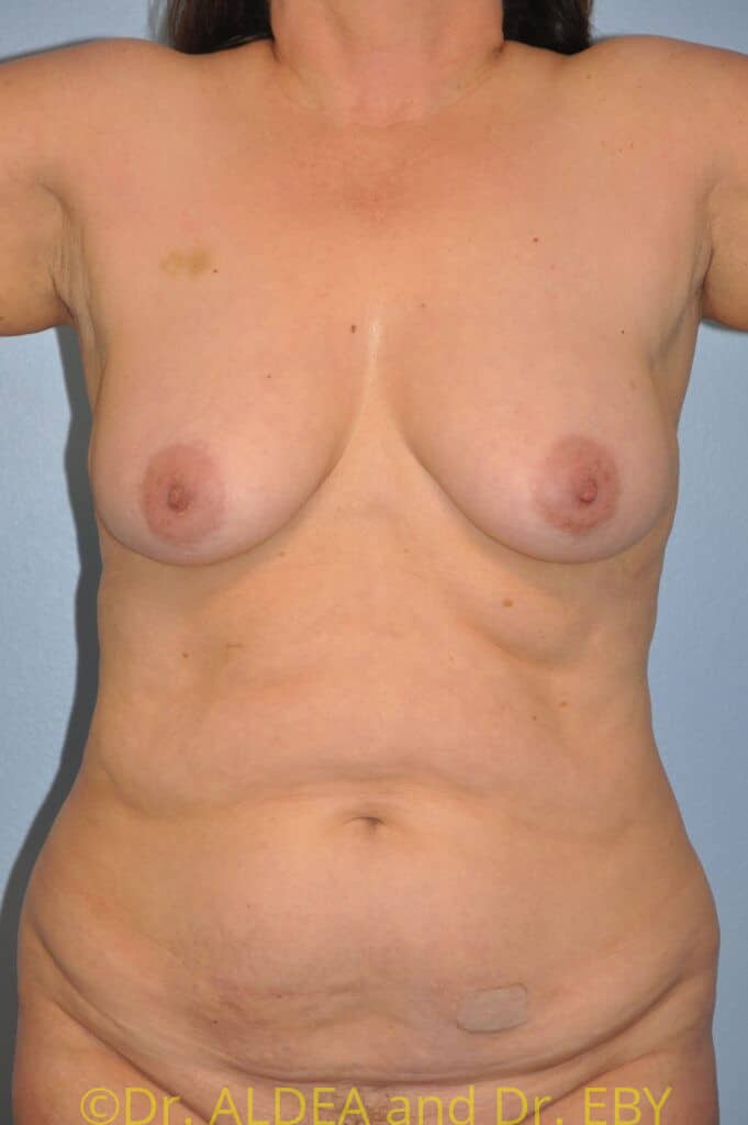 Before Image: Mommy Makeover #679 - front