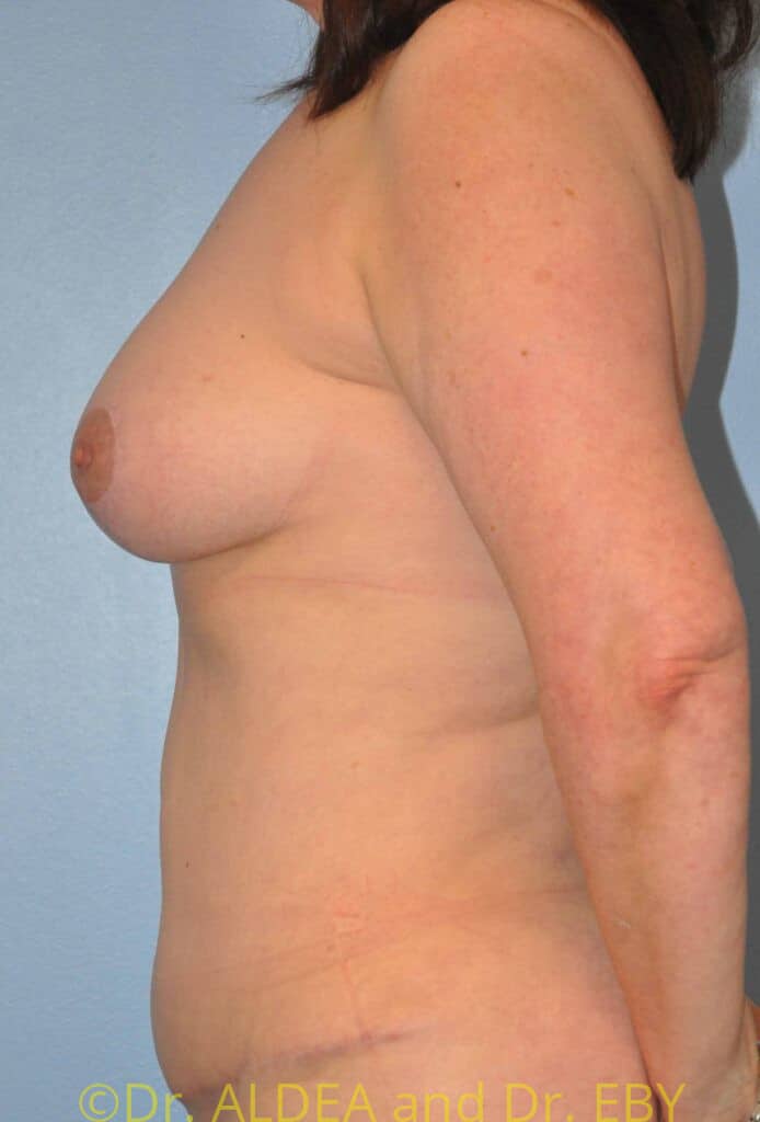 After Image: Mommy Makeover #679 - left-side
