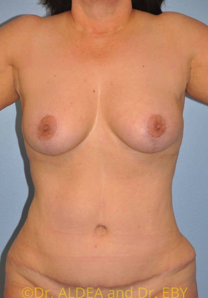 After Image: Mommy Makeover #679 - front