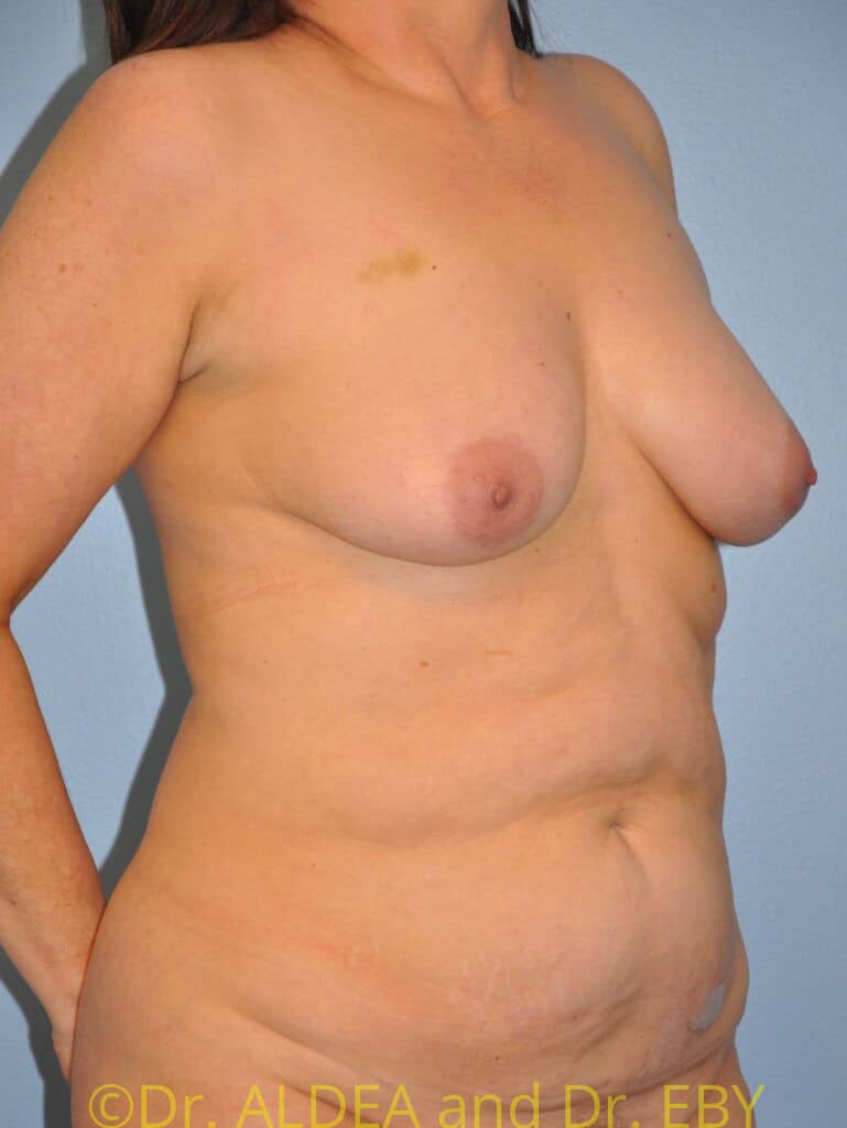 Before Image: Mommy Makeover #679 - right-front-oblique