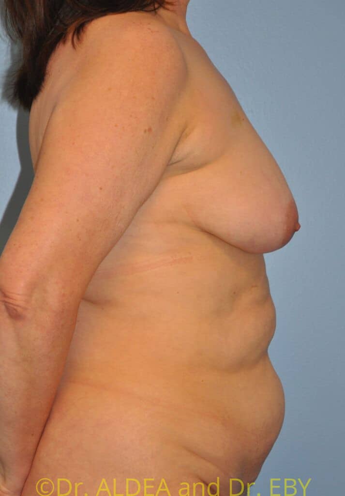 Before Image: Mommy Makeover #679 - right-side