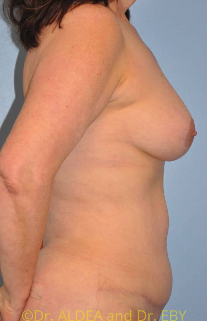 After Image: Mommy Makeover #679 - right-side