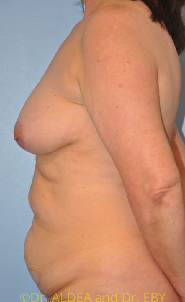 Before Image: Mommy Makeover #679 - left-side