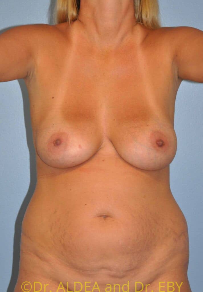 Before Image: Tummy Tuck #675 - front