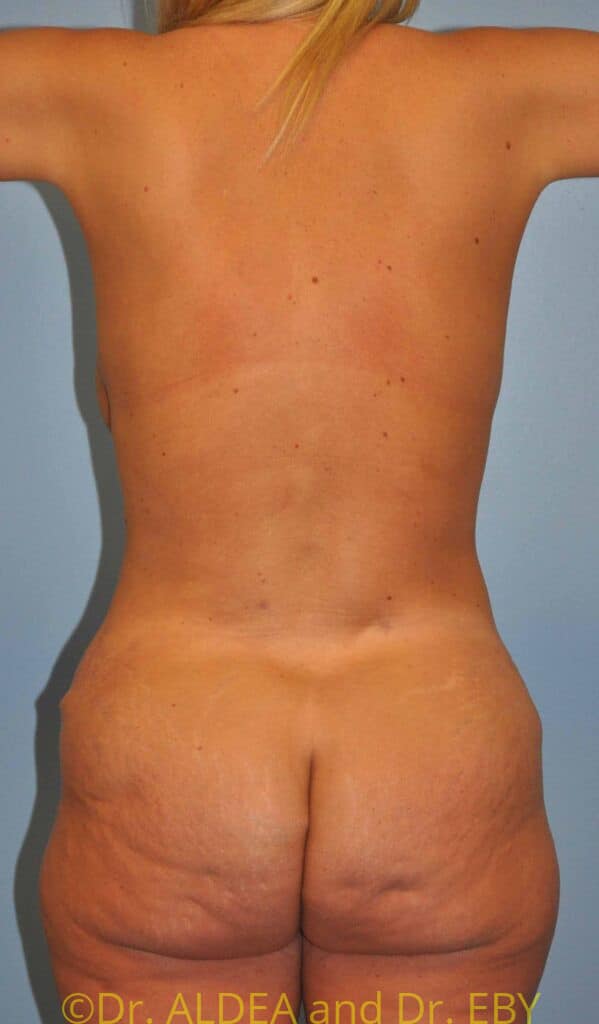 After Image: Tummy Tuck #675 - back