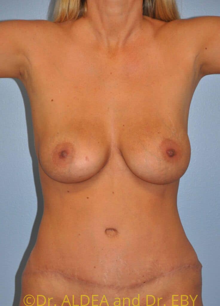 After Image: Tummy Tuck #675 - front