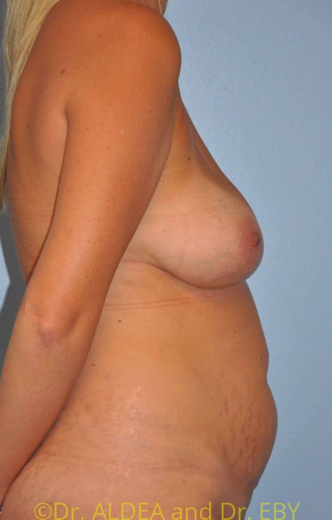 Before Image: Tummy Tuck #675 - right-side
