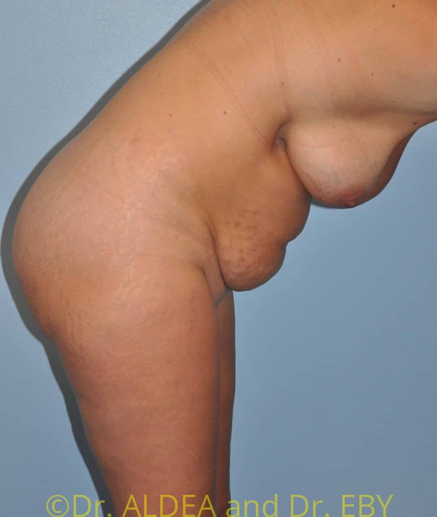 Before Image: Tummy Tuck #675 - other