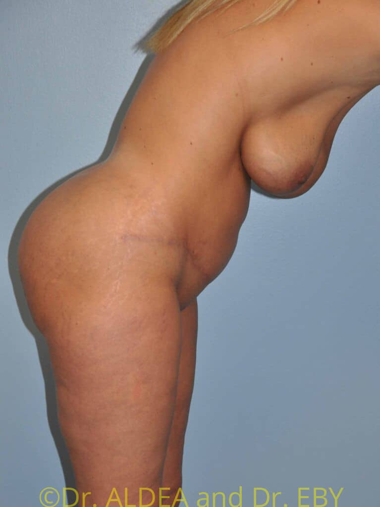 After Image: Tummy Tuck #675 - other
