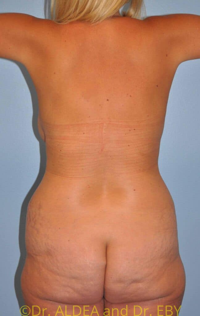 Before Image: Tummy Tuck #675 - back