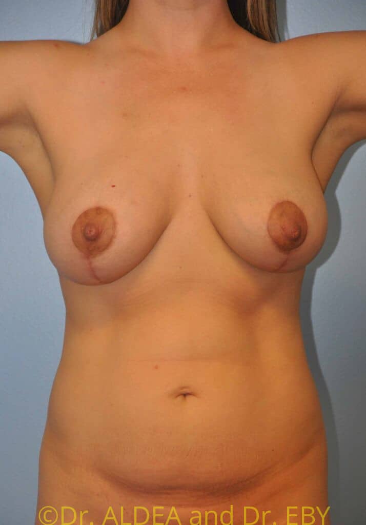 After Image: Breast Augmentation w/ Lift #658 - front