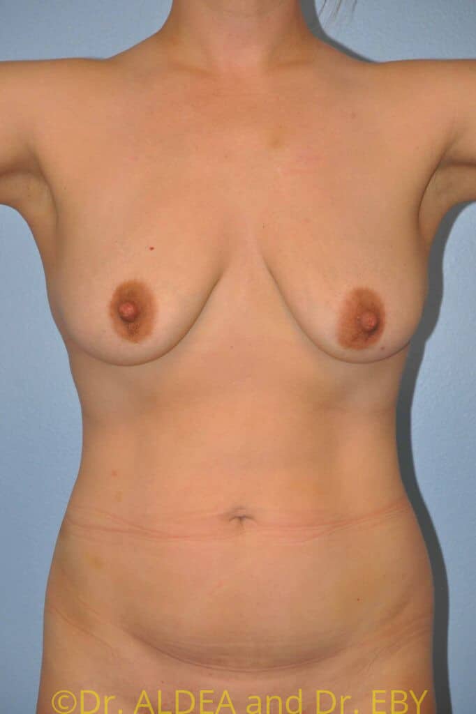 Before Image: Breast Augmentation w/ Lift #658 - front